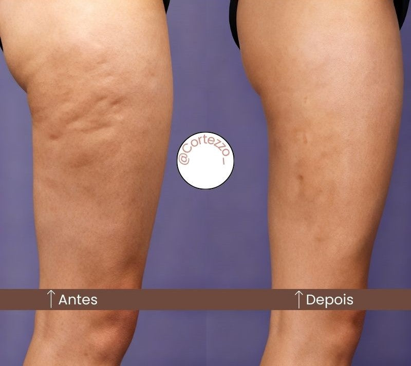 LipoWave - Massageador Corporal Anticelulite Cortezzo